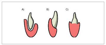 1. Irudia: Hortzak nola finkatzen diren: A. Tekondotoa; B. Pleurodontoa; C. Akrodontoa.<br>
